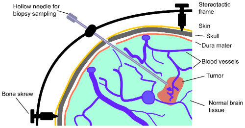 Diagram of biopsy