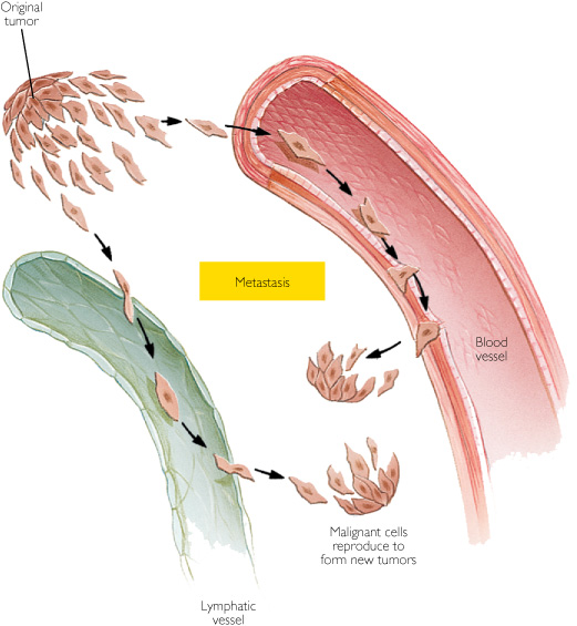 Diagram of matastasis