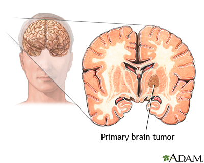 Primary Brain Tumour